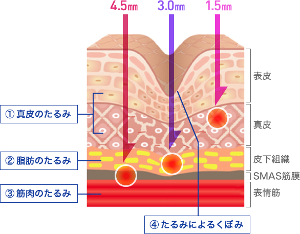 メスを使わない最先端たるみ治療